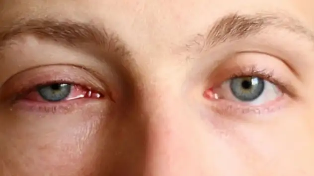 Konya'da göz hekimleri bilimsel toplantı düzenlendi: Korkunç, gerçeği açıkladılar!