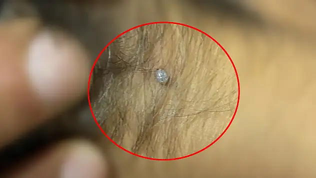 Konya'da kene kabusu! 4 yaşındaki çocuğun...