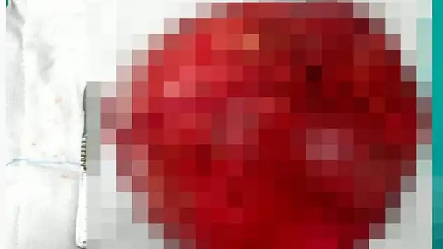 Konya'da tıp başarısı: Rahimden 40 santimetrelik dev kitle çıkarıldı