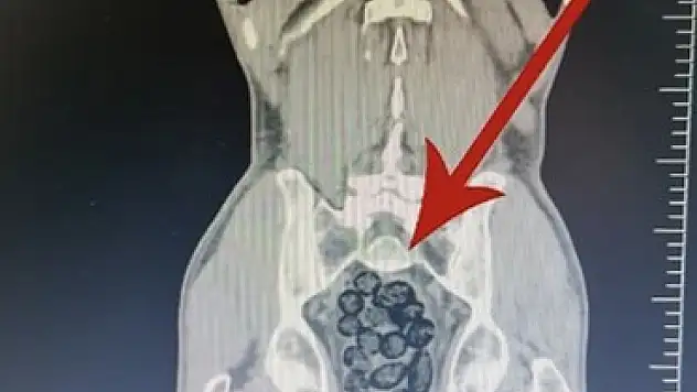 Otobüste yakalanan yolcunun midesinden 64 parça uyuşturucu çıktı!