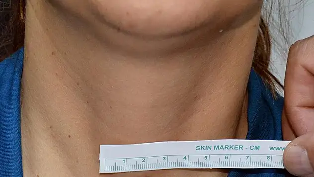 Tiroid kanserinde ezber bozan açıklama: Her hastaya şart değil