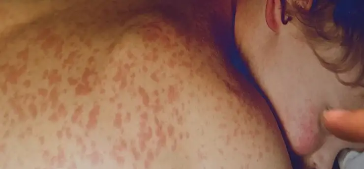 Kızamık yeniden alarm veriyor! Çocuklarda beyin hasarı riski