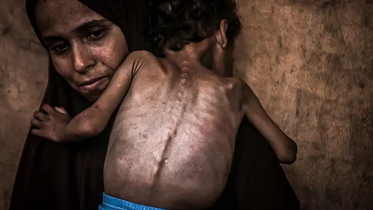 2 yaşındaki çocu açlıkla savaşıyor