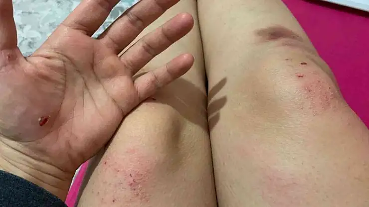 İşe giden kadına köpekler saldırdı