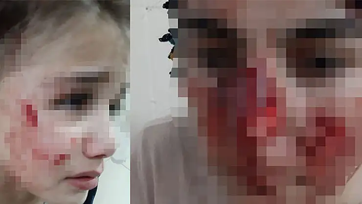 Yine sokak köpeği vahşeti: Vatandaşların yüzleri parçalandı