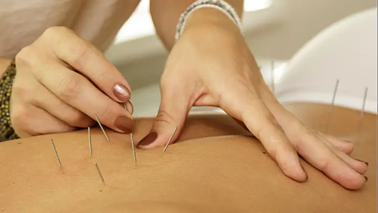 Akupunktur tedavisinin nedir? Gelenekten modern sağlığa...