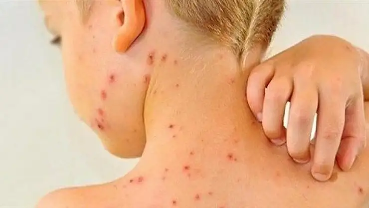 Anne ve babalara uzmanından kritik uyarılar… Kızamık ölümcül olabilir