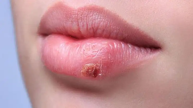 DİKKAT! Bu virüs görme kaybına yol açabilir