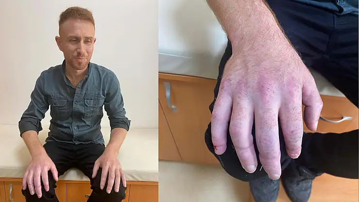 Dört Parmağı Koptu 16 Saat Sonra Dikildi