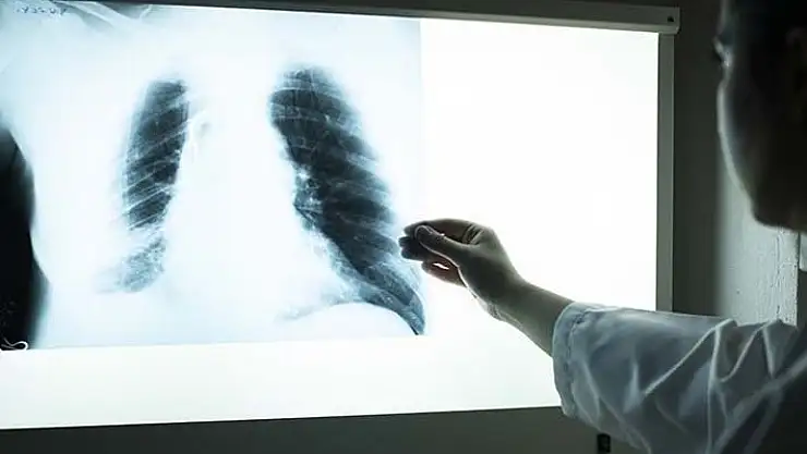 Dünyada 2021'de 1,6 milyon kişi verem nedeniyle yaşamını kaybetti