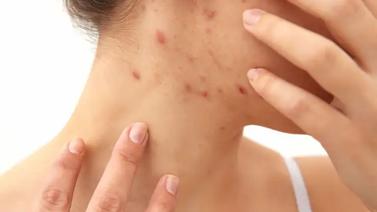 Faydalarına inanamayacaksınız! Gül suyunun bilinmeyenleri...