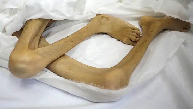 Gazze'de yetersiz beslenme nedeniyle bir çocuk hayatını kaybetti