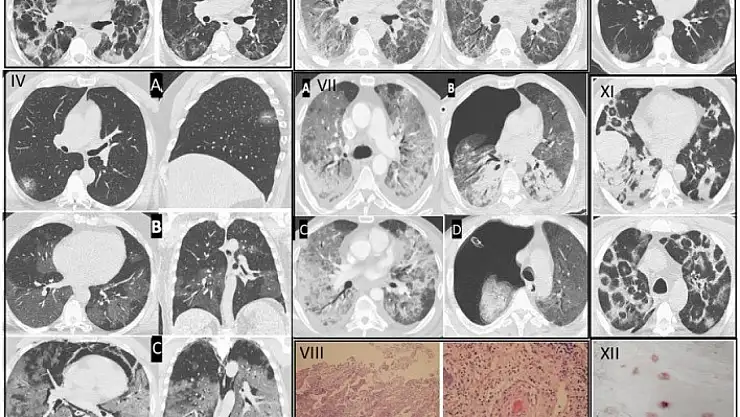 Gençlerde artan ani ölümlerin nedeni, pandemiye dayanıyor