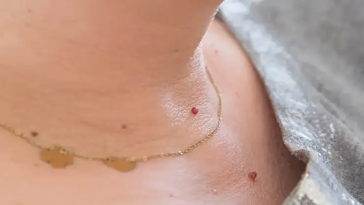 Kırmızı benler zararsız mı, yoksa uyarı işareti mi? Konya'daki uzman cevapladı!