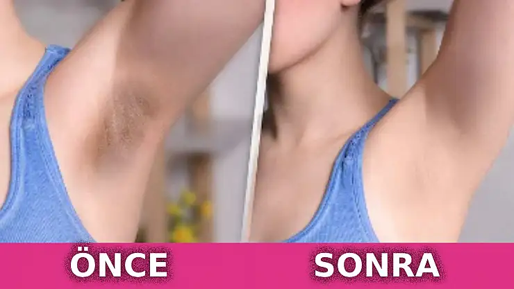 Koltuk altı kararmasına doğal çözüm! Bu iki malzeme yüzde yüz etki ediyor…