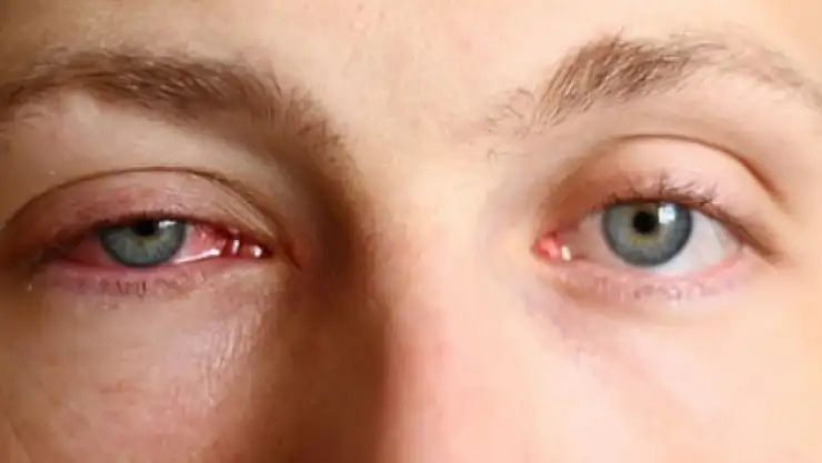 Konya'da göz hekimleri bilimsel toplantı düzenlendi: Korkunç, gerçeği açıkladılar!