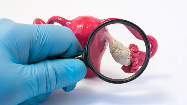 Polikistik Over Sendromu (PCOS) hakkında bilinmesi gerekenler neler? Polikistik Over Sendromu nedir?