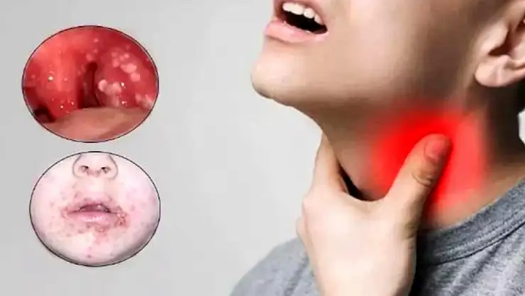 Sağlık Bakanlığı Strep A bakterisine karşı uyardı