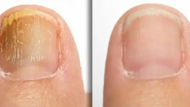 Tırnak mantarı neden olur? Tırnak mantarını en hızlı geçiren 4 güzellik tüyosu