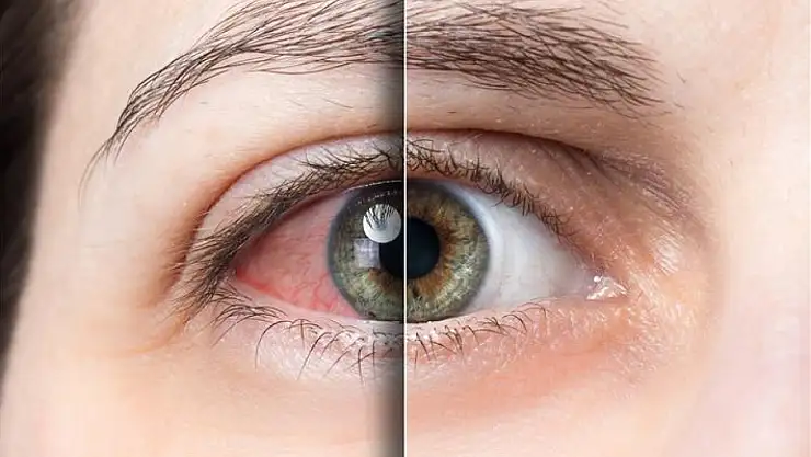 Uzun Süre Ekrana Bakmak Göz Hastalıklarını Artırıyor