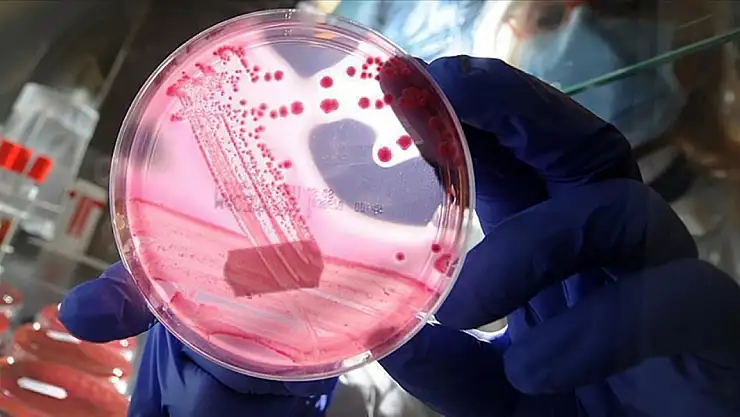 Yumurtalık kanserini erken teşhis edebilecek proteinler keşfetti