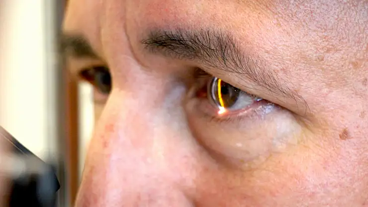 Yüzde 95 görme kaybı bulunan keratokonus hastası, kornea nakli sonrası görmeye başladı