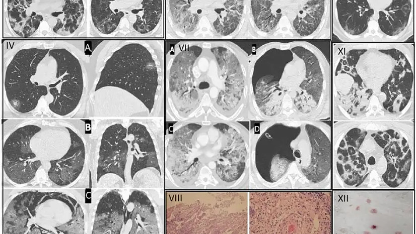 Gençlerde artan ani ölümlerin nedeni, pandemiye dayanıyor