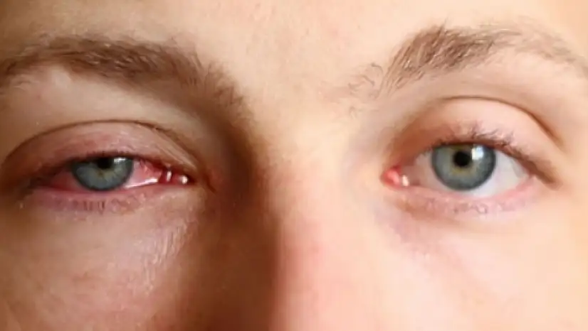 Konya'da göz hekimleri bilimsel toplantı düzenlendi: Korkunç, gerçeği açıkladılar!