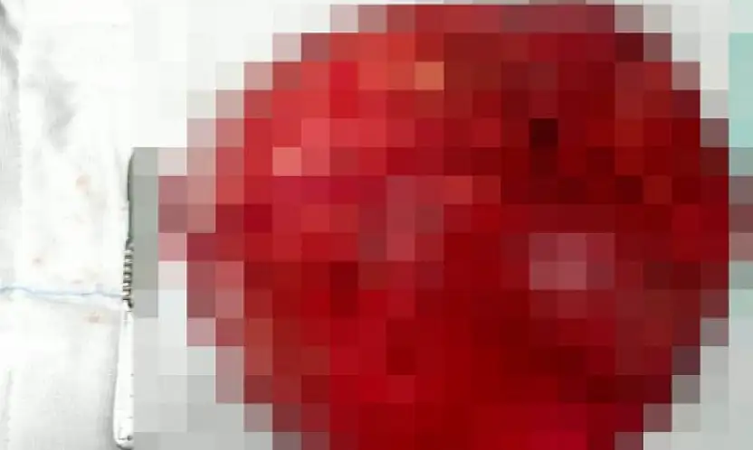 Konya'da tıp başarısı: Rahimden 40 santimetrelik dev kitle çıkarıldı