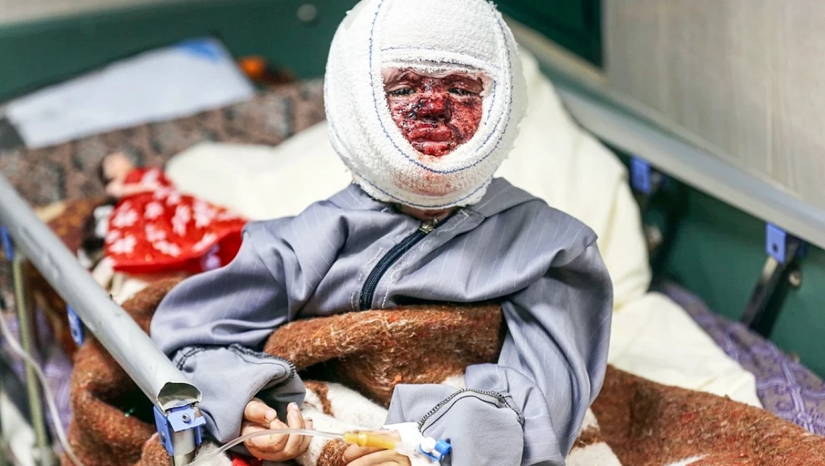 4 yaşındaki Filistinli Seca Cuneyd, yüzündeki derin yanıklarla mücadele ediyor