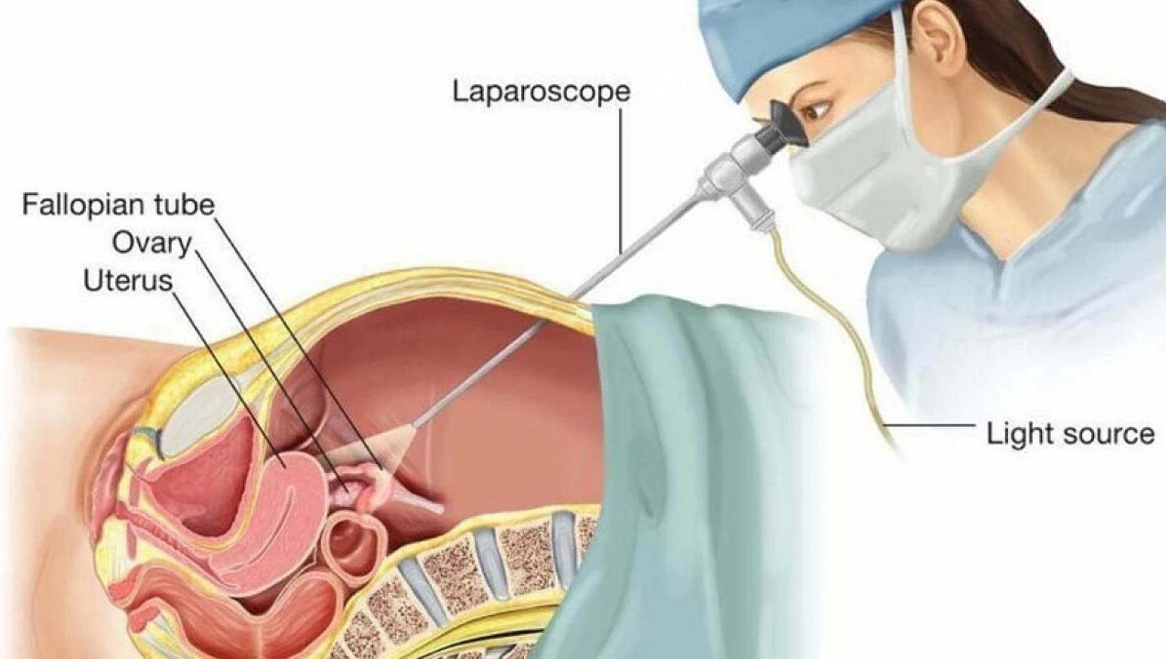Laparoskopik Cerrahi Nedir?