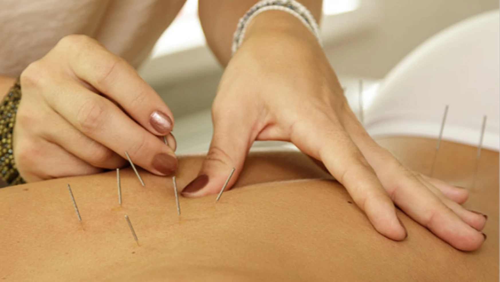 Akupunktur tedavisinin nedir? Gelenekten modern sağlığa...
