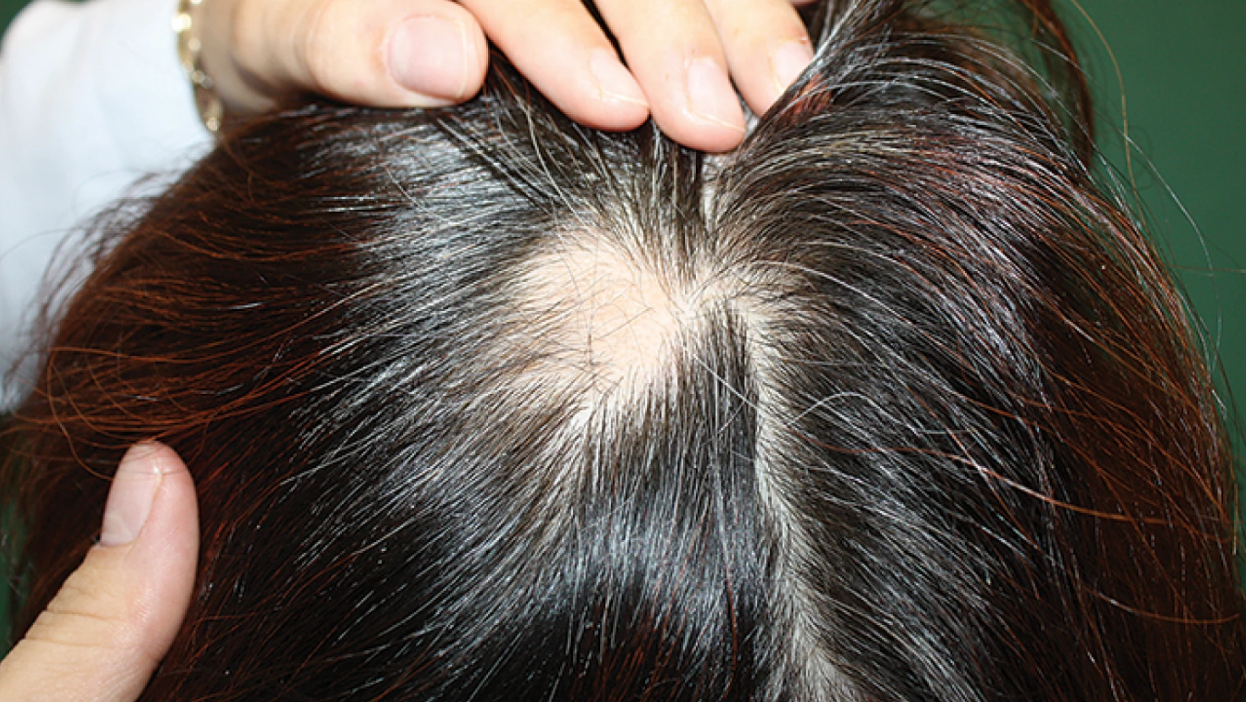 Çağımızın hastalığı saç dökülmesine karşı ne yapılmalıdır?
