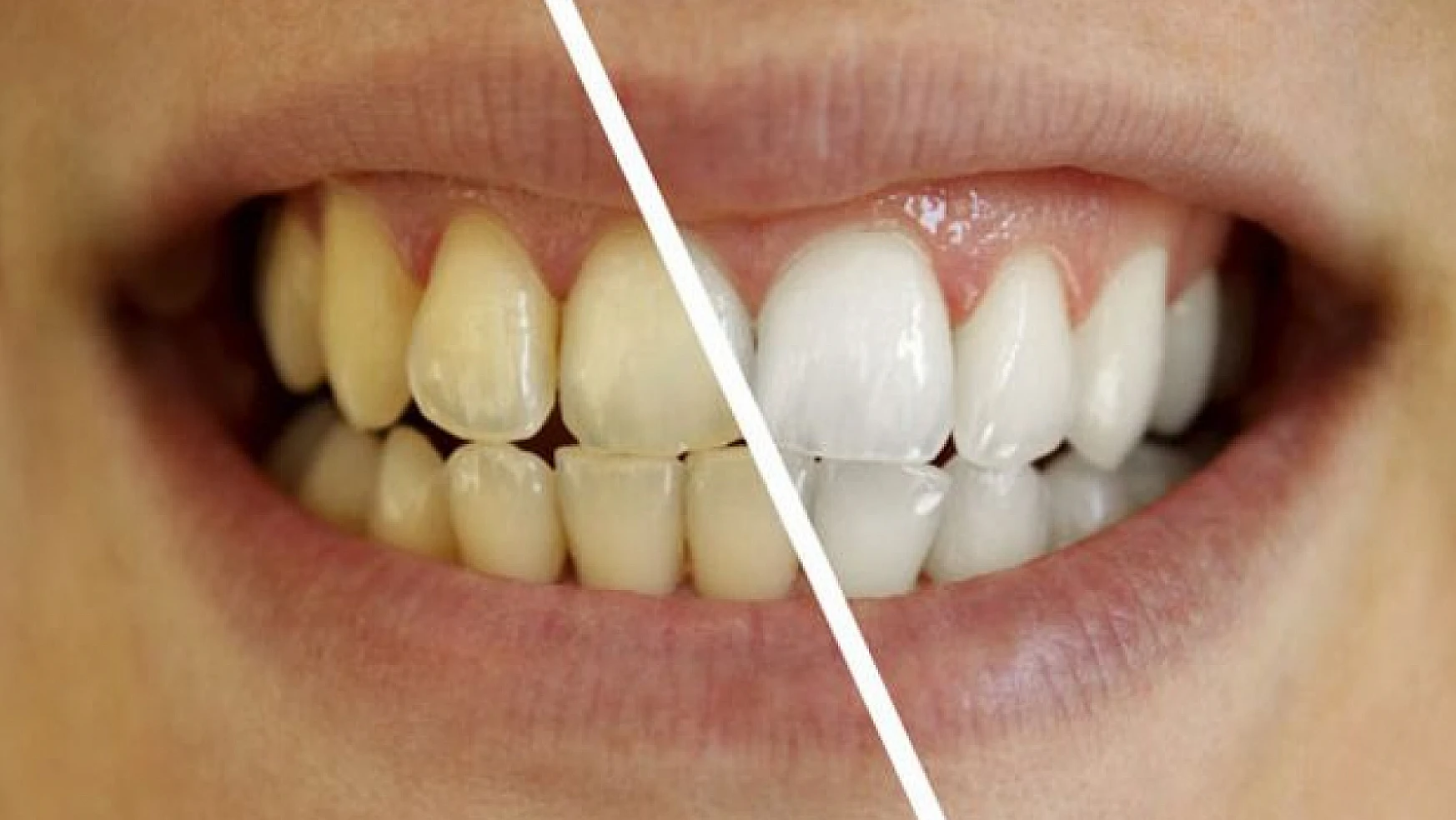 Doğal diş beyazlatma yöntemleri